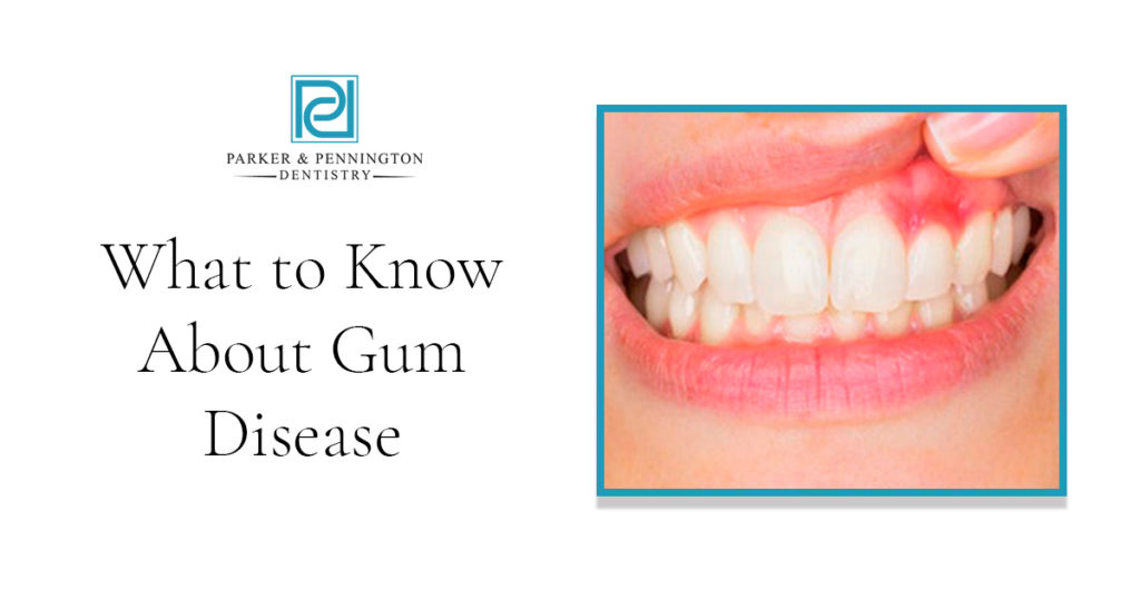 What to Know About Gum Disease - Parker & Pennington Dentistry